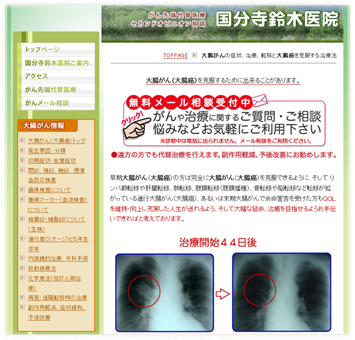 大腸癌イメージ 大腸癌イメージ