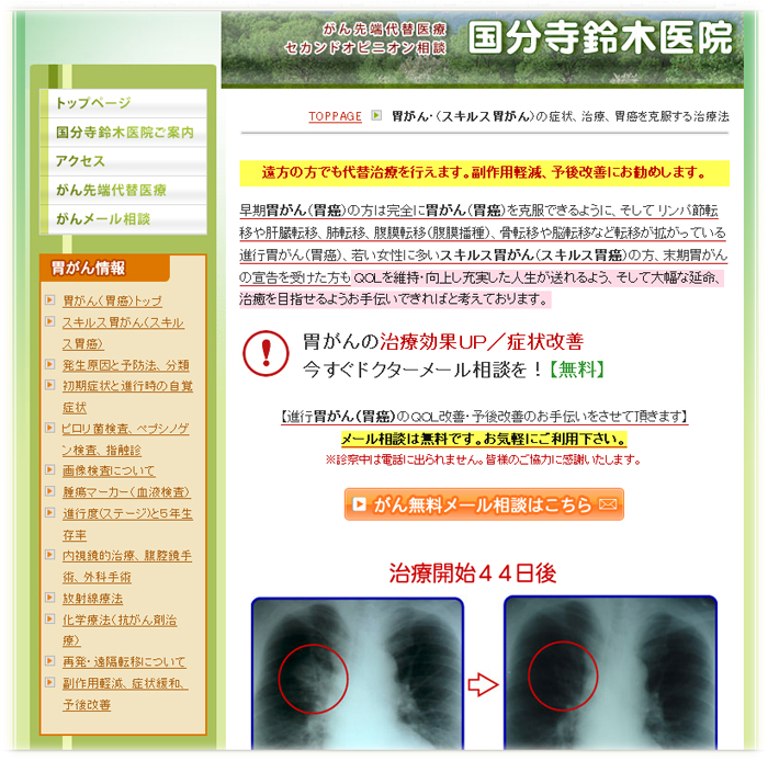 胃癌イメージ